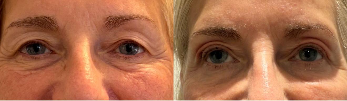 Plasma fibroblast before and after — both eyes showing smoother, lifted upper lids and softened crepey skin