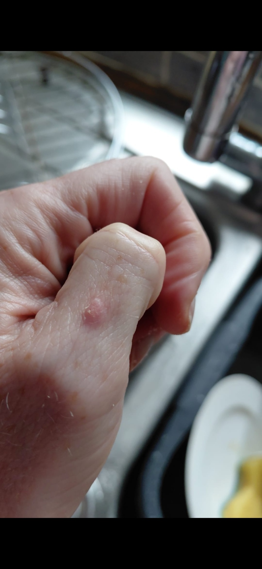 Wart on thumb before plasma pen treatment