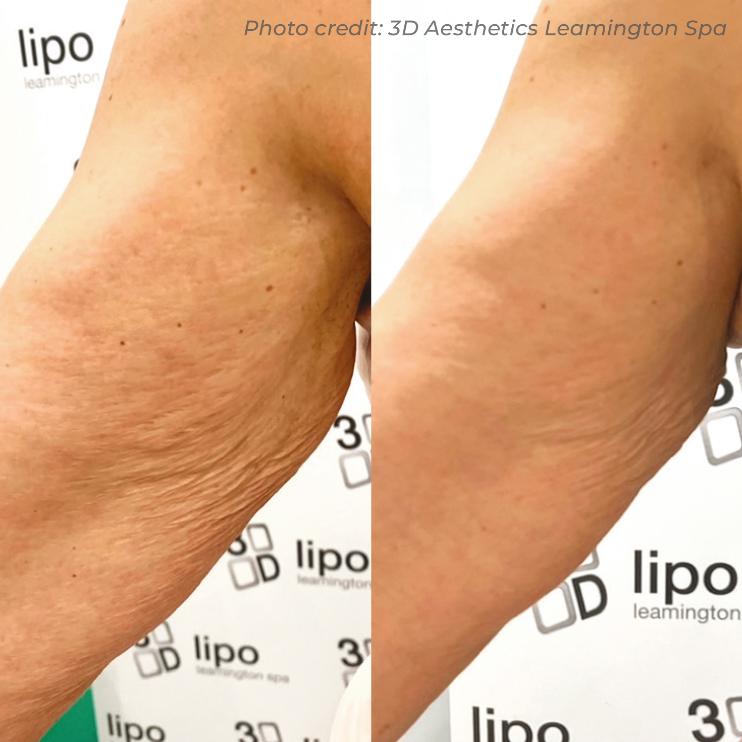 Dermaforce upper arm skin tightening before and after — three sessions