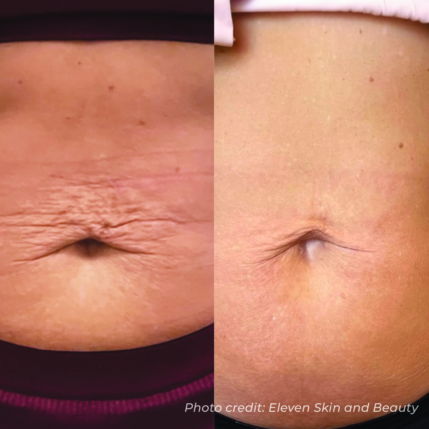 Dermaforce abdomen before and after — smoother skin and reduced stretch marks