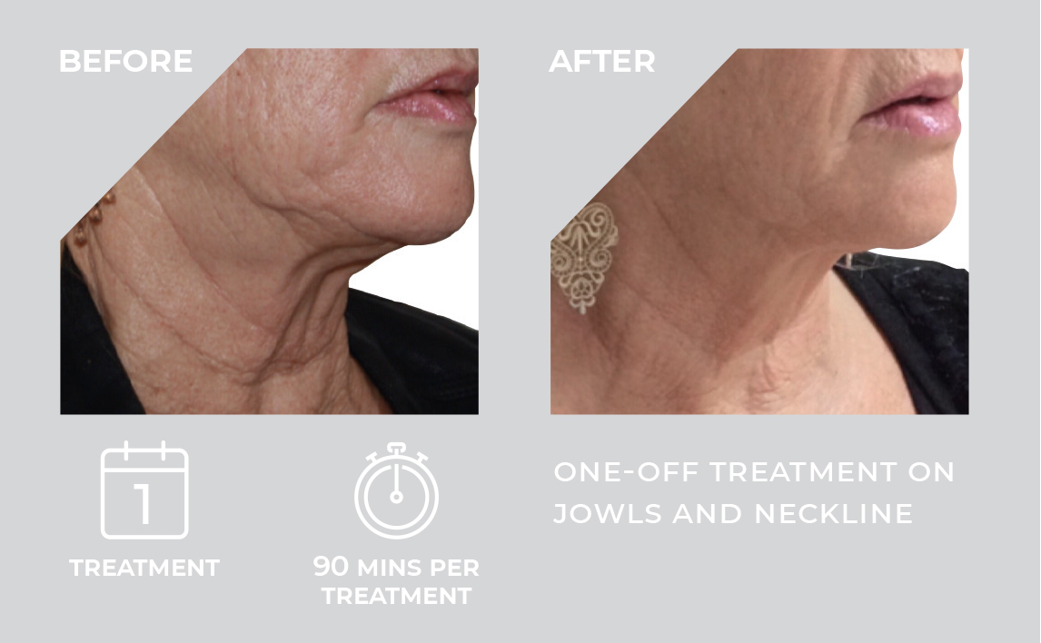 HIFU 3D treatment results — jowls and neck lifting