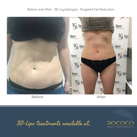 3D-cryolipolysis - Targeted Fat Reduction
